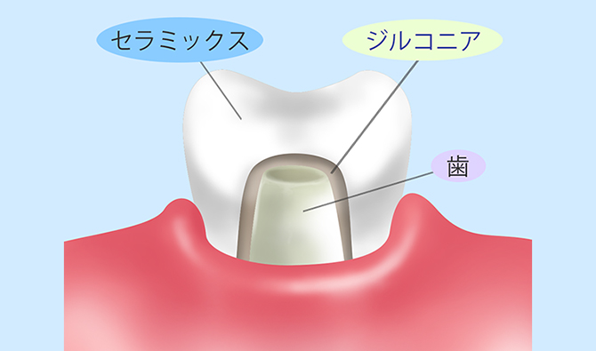 ジルコニア