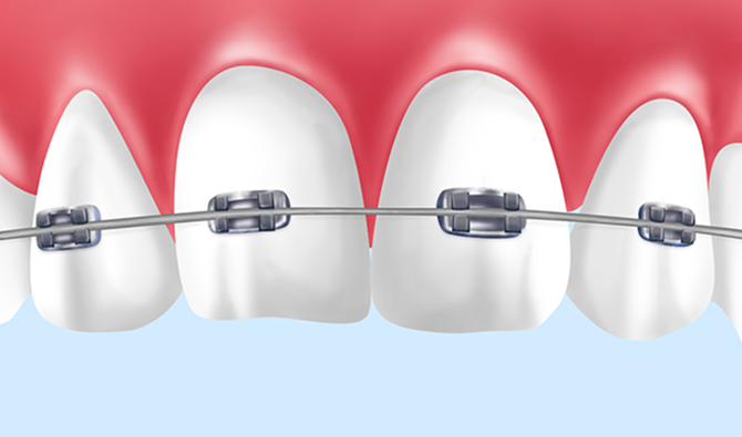 ブラケット矯正
