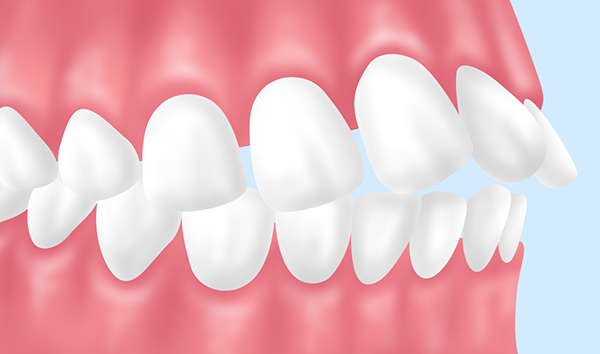 【上顎前突/出っ歯】