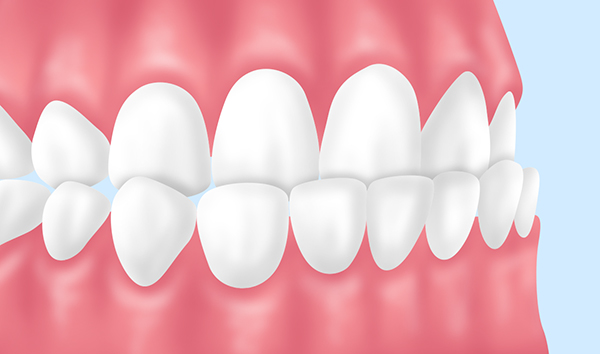 【反対咬合/受け口】
