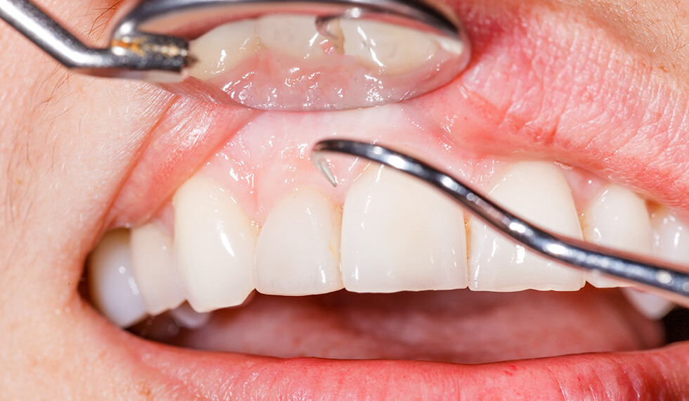 お口と全身の健康を守る歯周病治療