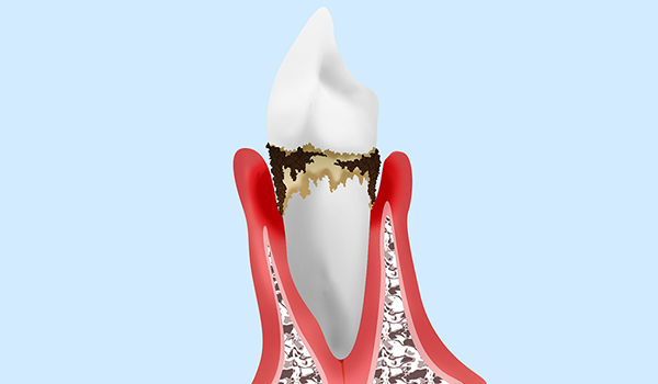 重度歯周炎の治療