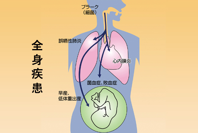 歯周病と全身疾患について