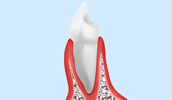 【歯肉炎】