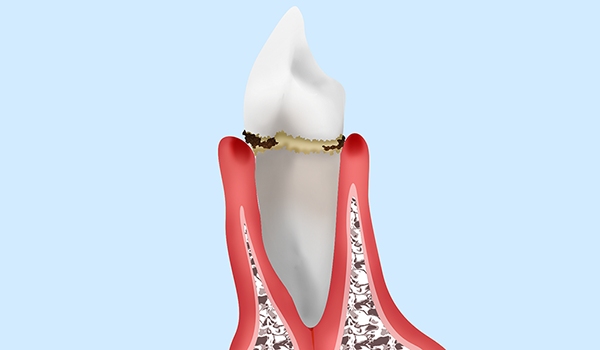 【軽度歯周炎】