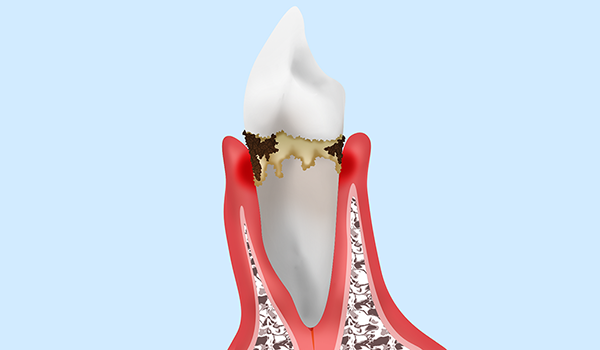 中等度歯周炎の治療