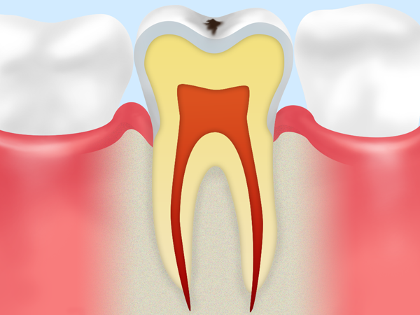 歯の表面のエナメル質の虫歯