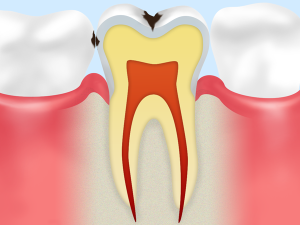 歯の溝の初期虫歯