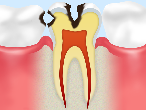 象牙質まで進行した虫歯
