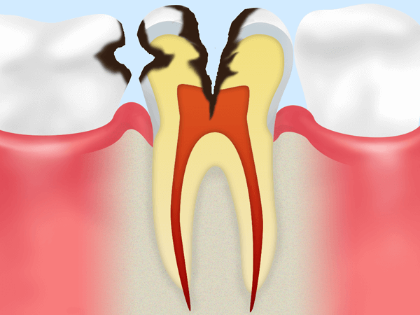 歯の神経まで達した虫歯